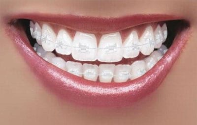 6 month braces advertisement, services featured image