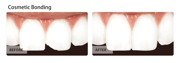 Before and After Cosmetic Bonding procedure