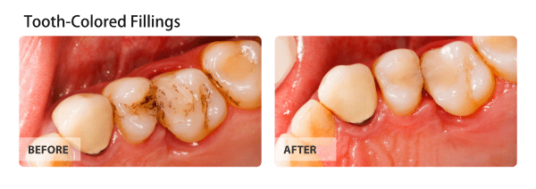 Before and After Tooth- Colored Fillings procedure