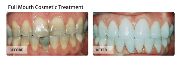 Before and After Full Mouth Cosmetic Treatment