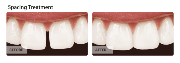 Before and After Spacing treatment procedure