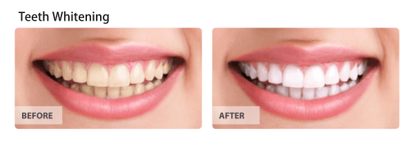 Before and After Teeth Whitening Treatment